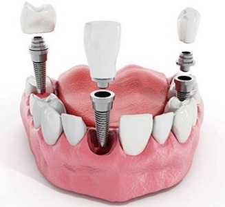 Nelank Dental Services | Dental implants
