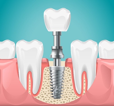Dental Implants in Harare 